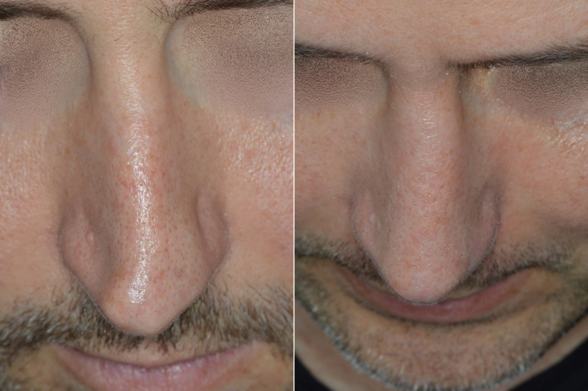 Rhinoplasty Before and After Photos in Miami, FL, Patient 5180