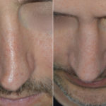 Rhinoplasty Before and After Photos in Miami, FL, Patient 5180