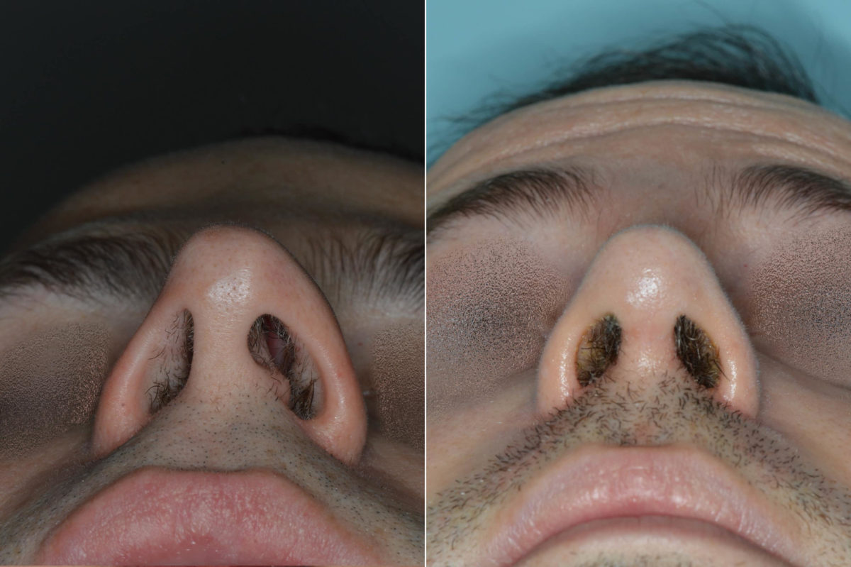 Rhinoplasty Before and After Photos in Miami, FL, Patient 5180