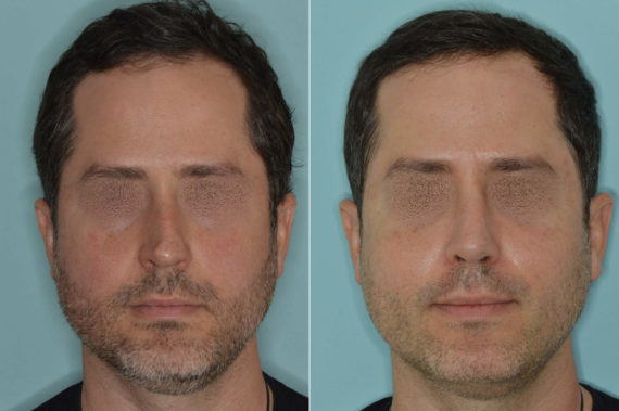 Rhinoplasty Before and After Photos in Miami, FL, Patient 5180