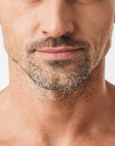 Facial and Beard Transplantation