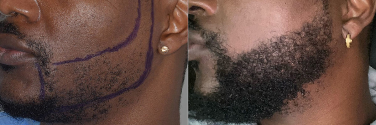 Beard Transplant Before and After Photos in Miami, FL, Patient 5619