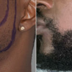 Beard Transplant Before and After Photos in Miami, FL, Patient 5619