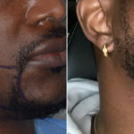 Beard Transplant Before and After Photos in Miami, FL, Patient 5619