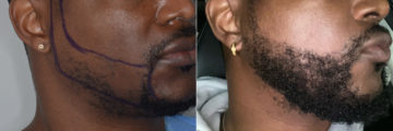 Beard Transplant Before and After Photos in Miami, FL, Patient 5619