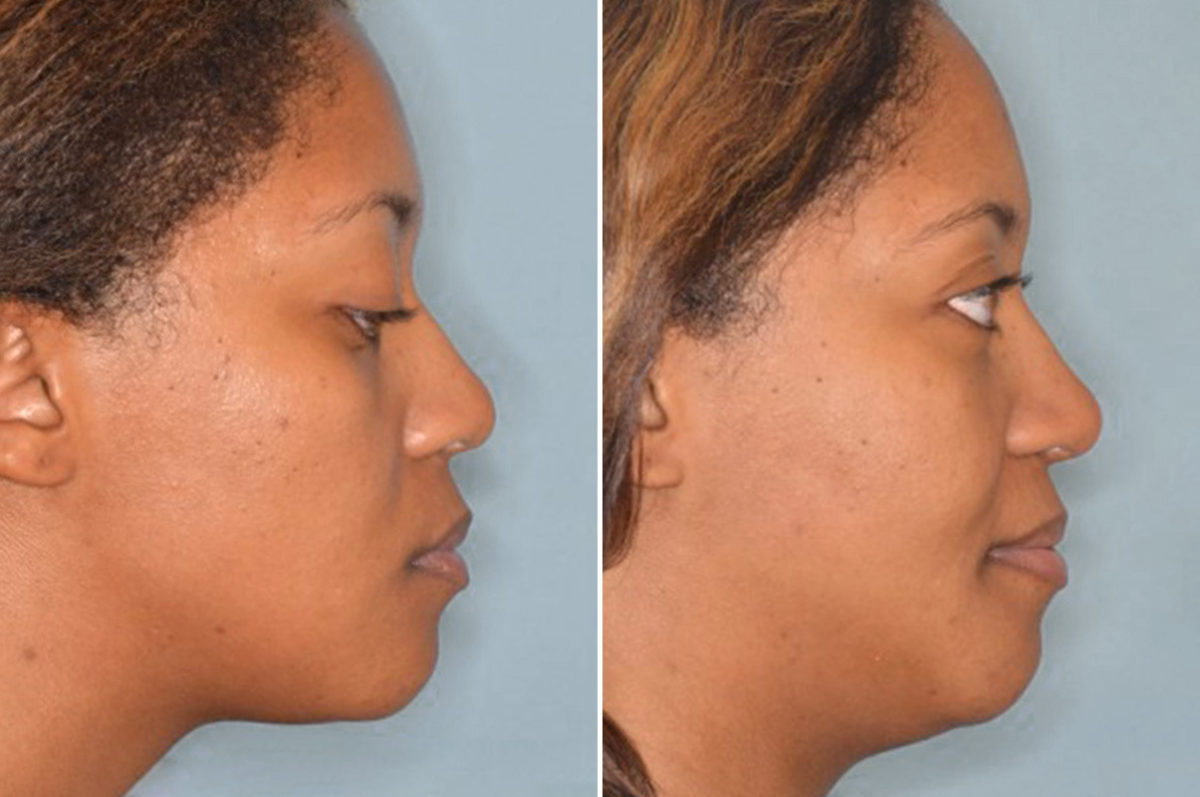 Ethnic Rhinoplasty Before and After Photos in Miami, FL, Patient 1004