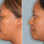 Ethnic Rhinoplasty Before and After Photos in Miami, FL, Patient 1004