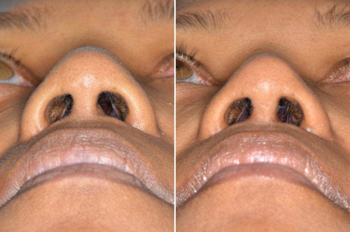 Ethnic Rhinoplasty Before and After Photos in Miami, FL, Patient 1004