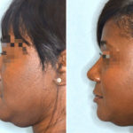 Ethnic Rhinoplasty Before and After Photos in Miami, FL, Patient 1028