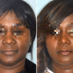 Ethnic Rhinoplasty Before and After Photos in Miami, FL, Patient 1028