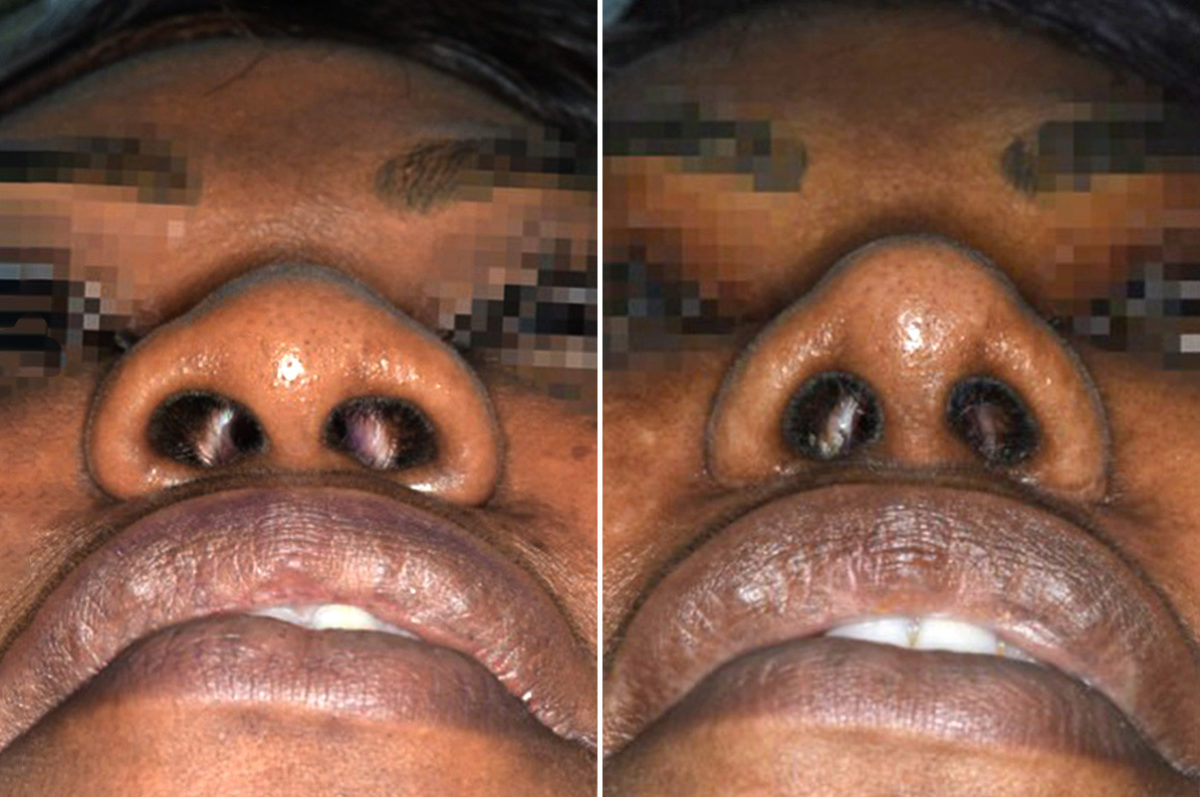 Ethnic Rhinoplasty Before and After Photos in Miami, FL, Patient 1048