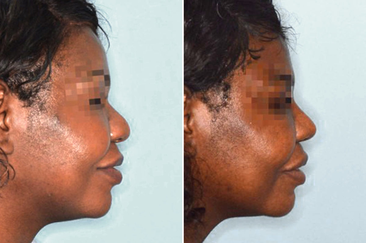 Ethnic Rhinoplasty Before and After Photos in Miami, FL, Patient 1048