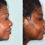 Ethnic Rhinoplasty Before and After Photos in Miami, FL, Patient 1048