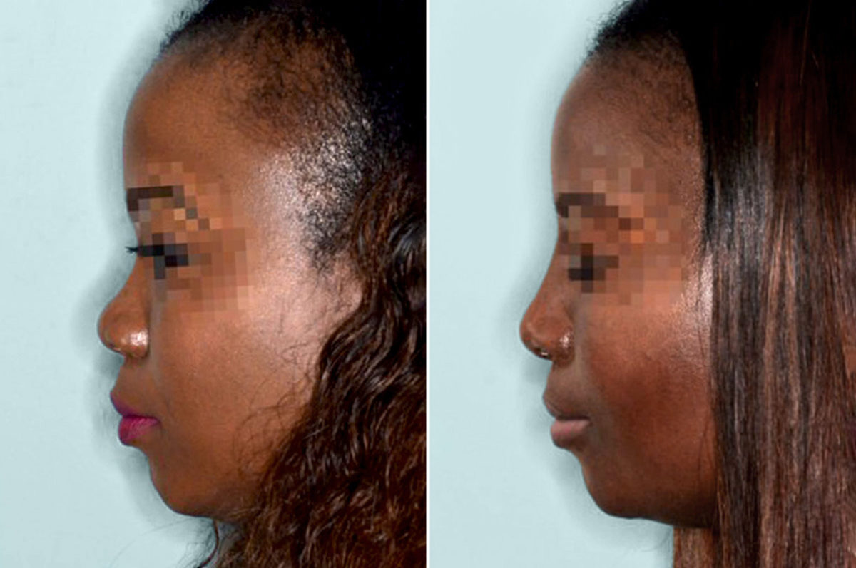 Ethnic Rhinoplasty Before and After Photos in Miami, FL, Patient 1056