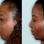 Ethnic Rhinoplasty Before and After Photos in Miami, FL, Patient 1056