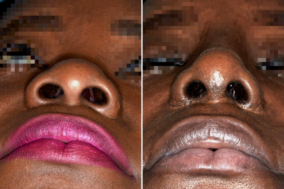 Ethnic Rhinoplasty Before and After Photos in Miami, FL, Patient 1056