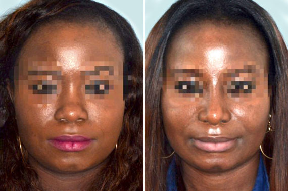 Ethnic Rhinoplasty Before and After Photos in Miami, FL, Patient 1056