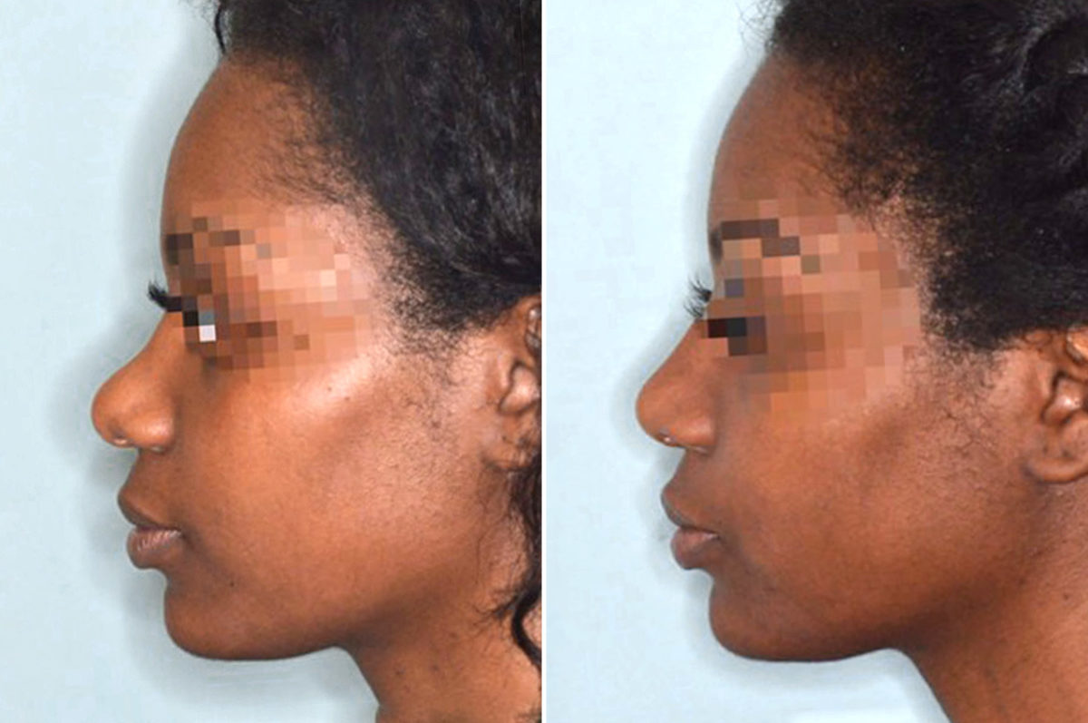 Ethnic Rhinoplasty Before and After Photos in Miami, FL, Patient 1066