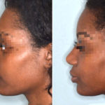 Ethnic Rhinoplasty Before and After Photos in Miami, FL, Patient 1066