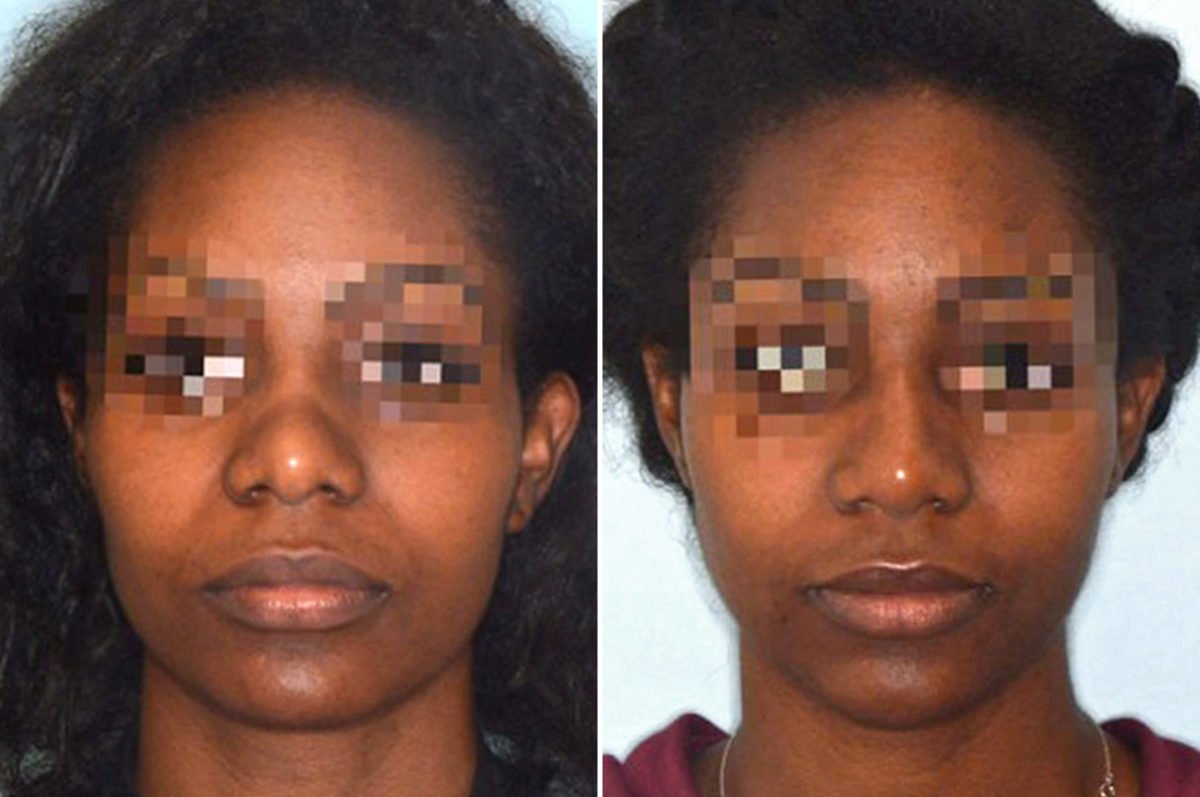 Ethnic Rhinoplasty Before and After Photos in Miami, FL, Patient 1066