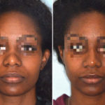 Ethnic Rhinoplasty Before and After Photos in Miami, FL, Patient 1066