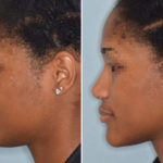 Ethnic Rhinoplasty Before and After Photos in Miami, FL, Patient 1076