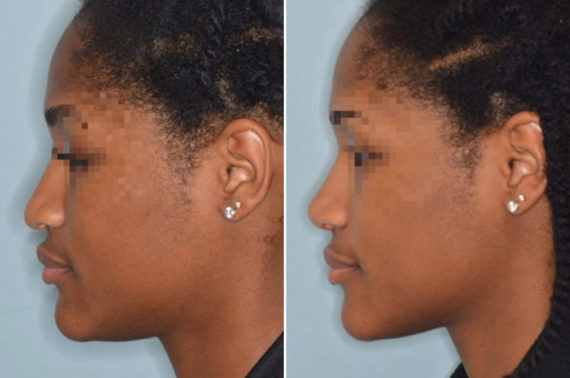 Ethnic Rhinoplasty Before and After Photos in Miami, FL, Patient 1076