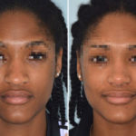 Ethnic Rhinoplasty Before and After Photos in Miami, FL, Patient 1076