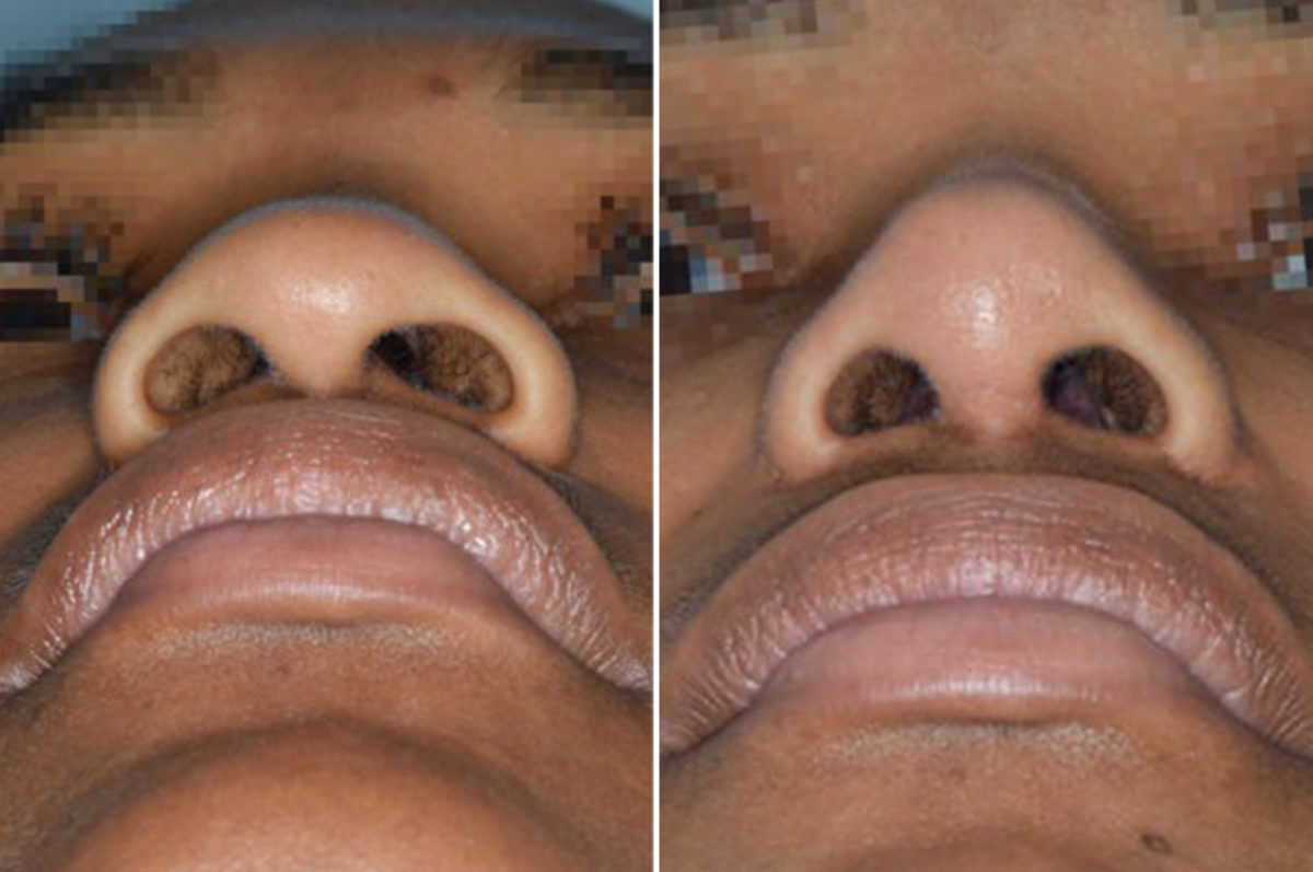 Ethnic Rhinoplasty Before and After Photos in Miami, FL, Patient 1076