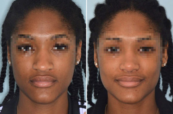 Ethnic Rhinoplasty Before and After Photos in Miami, FL, Patient 1076