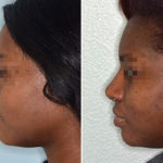 Ethnic Rhinoplasty Before and After Photos in Miami, FL, Patient 1083