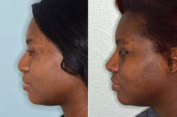 Ethnic Rhinoplasty Before and After Photos in Miami, FL, Patient 1083