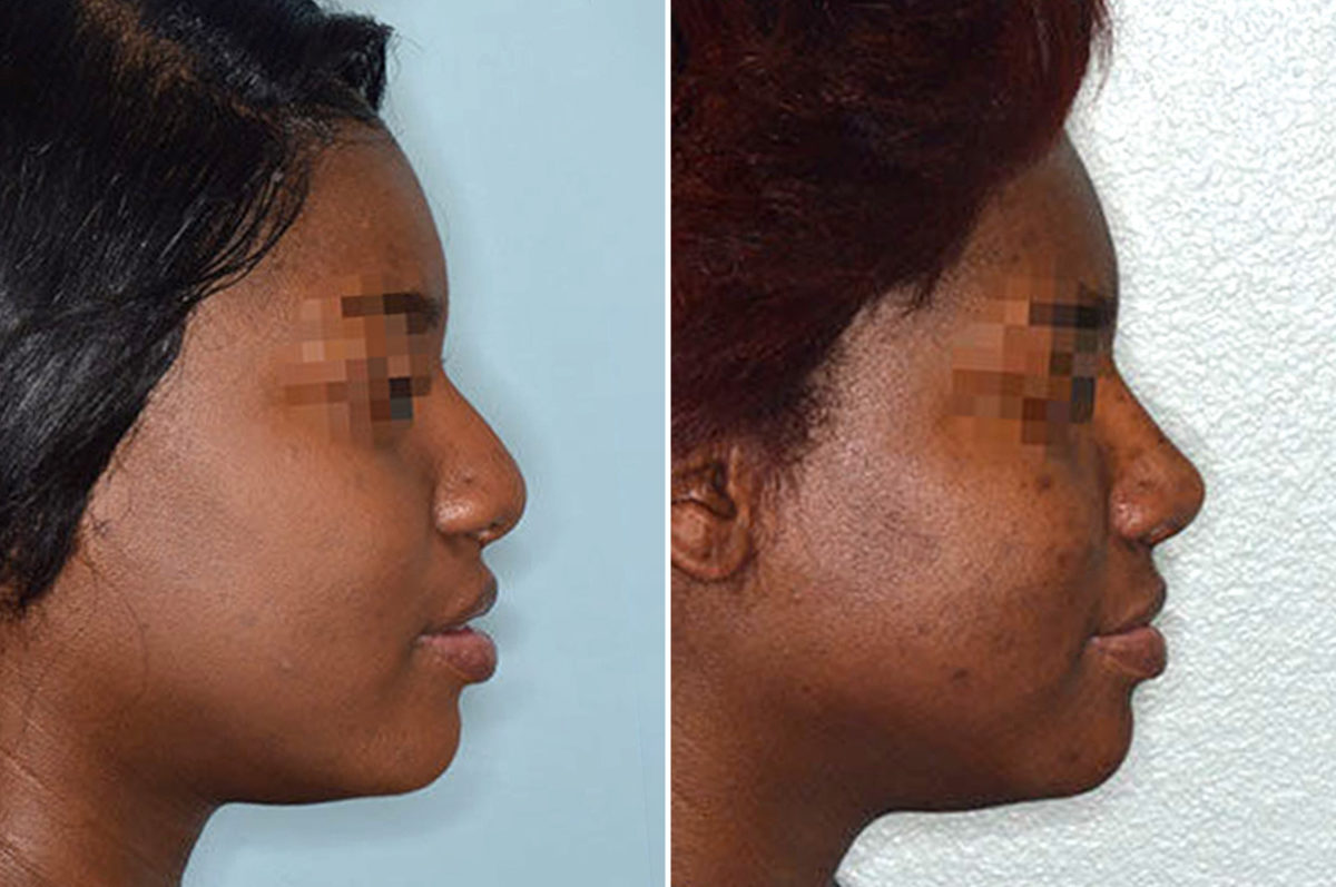 Ethnic Rhinoplasty Before and After Photos in Miami, FL, Patient 1083