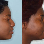 Ethnic Rhinoplasty Before and After Photos in Miami, FL, Patient 1083