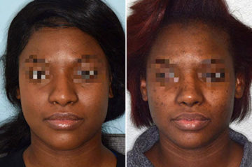 Ethnic Rhinoplasty Before and After Photos in Miami, FL, Patient 1083