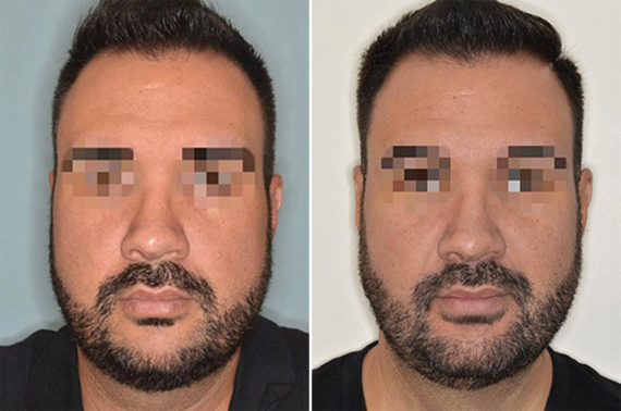 Cheek Reduction Before and After Photos in Miami, FL, Patient 1445