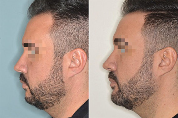 Cheek Reduction Before and After Photos in Miami, FL, Patient 1445