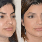 Cheek Reduction Before and After Photos in Miami, FL, Patient 1843