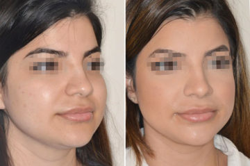 Cheek Reduction Before and After Photos in Miami, FL, Patient 1843