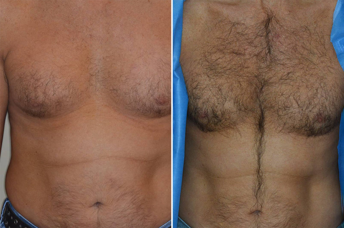 Body Hair Transplant Before and After Photos in Miami, FL, Patient 2108