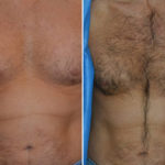 Body Hair Transplant Before and After Photos in Miami, FL, Patient 2108