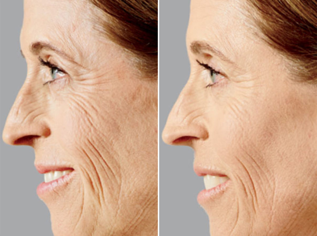 Voluma Photos Dr. Anthony Bared, M.D Facial Plastic Surgeon