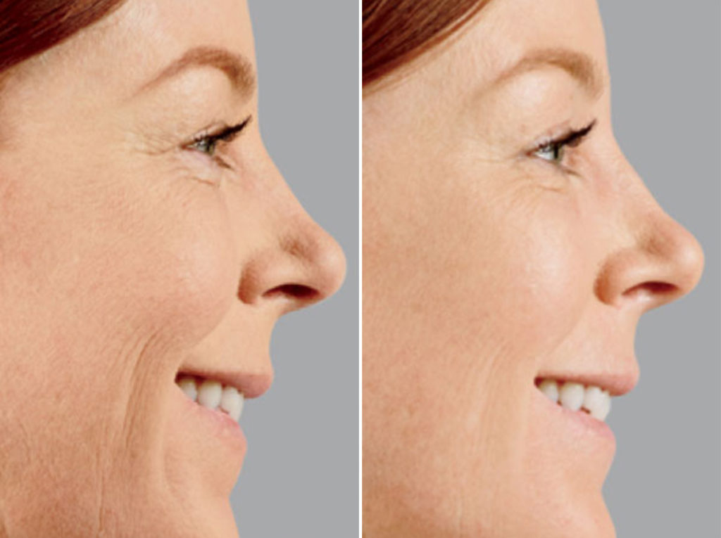 Voluma Photos Dr. Anthony Bared, M.D Facial Plastic Surgeon