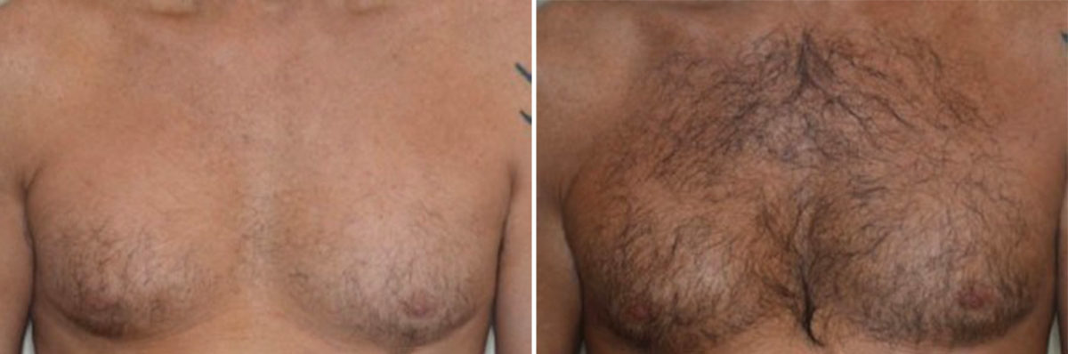 Body Hair Transplant Before and After Photos in Miami, FL, Patient 2717