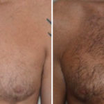 Body Hair Transplant Before and After Photos in Miami, FL, Patient 2717