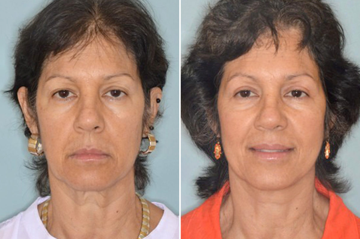 Brow Lift Before and After Photos in Miami, FL, Patient 2778