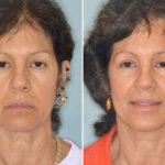 Brow Lift Before and After Photos in Miami, FL, Patient 2778