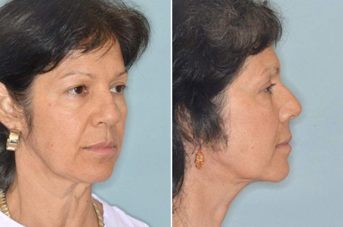 Brow Lift Before and After Photos in Miami, FL, Patient 2778