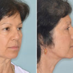 Brow Lift Before and After Photos in Miami, FL, Patient 2778