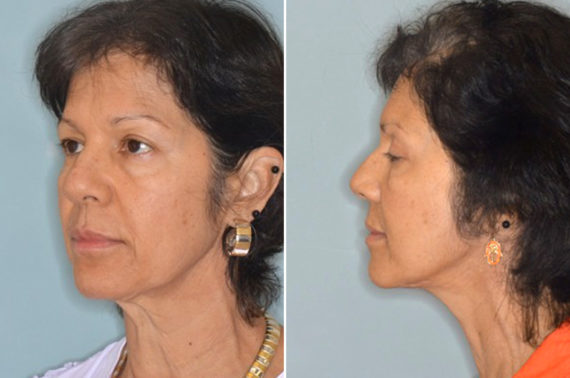 Brow Lift Before and After Photos in Miami, FL, Patient 2778